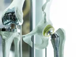 Orthopaedic Implants